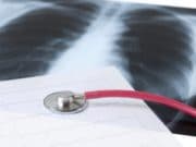 Световен ден за борба с туберкулозата е днес