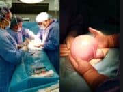 В „Уни Хоспитал“ успешно бе оперирана 3-килограмова миома