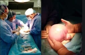 В „Уни Хоспитал“ успешно бе оперирана 3-килограмова миома