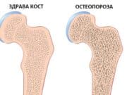 20 октомври – Световeн ден за борба с остеопорозата